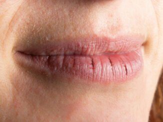 trockene Lippen tipps honig lippenpflege