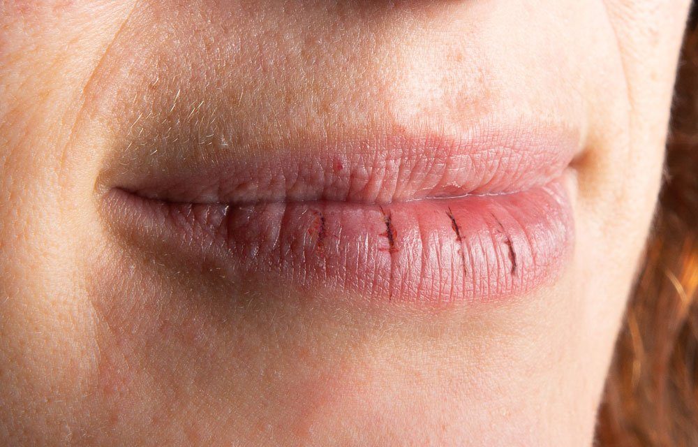 Der lippe stelle an trockene Trockene Lippen