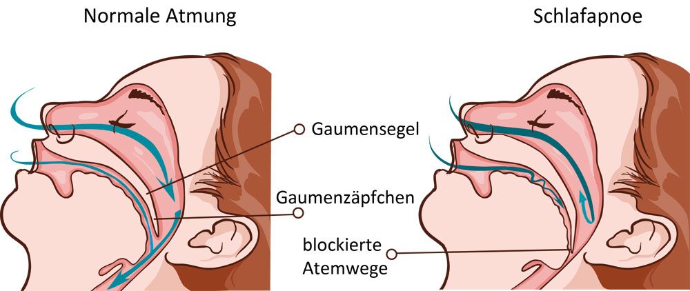 obstruktive Schlafapnoe Schlafapnoe Atmung